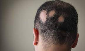 alopecia